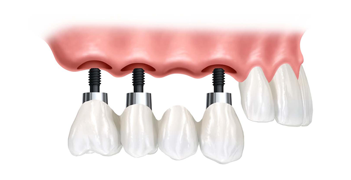 implantes-dentarios-1